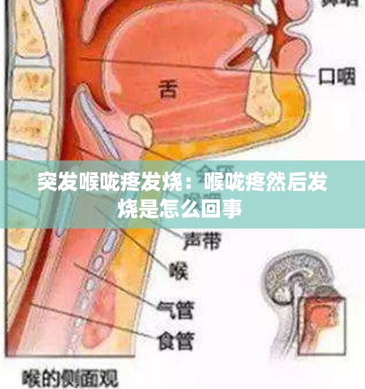 突发喉咙疼发烧：喉咙疼然后发烧是怎么回事 